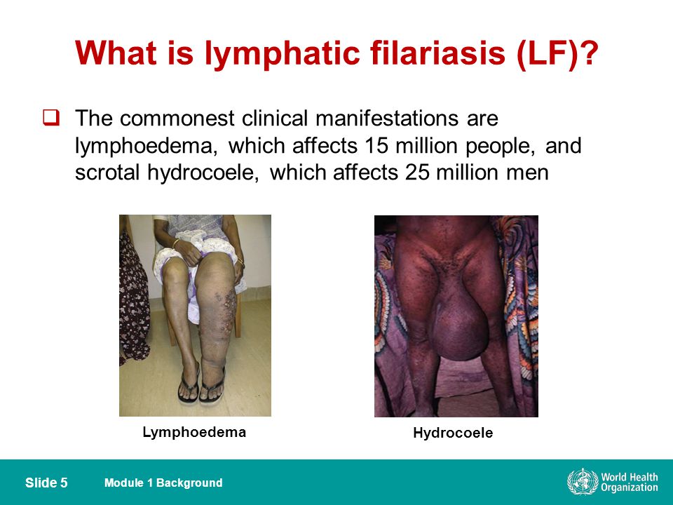 The clinical description of the disease elephantiasis or filariasis